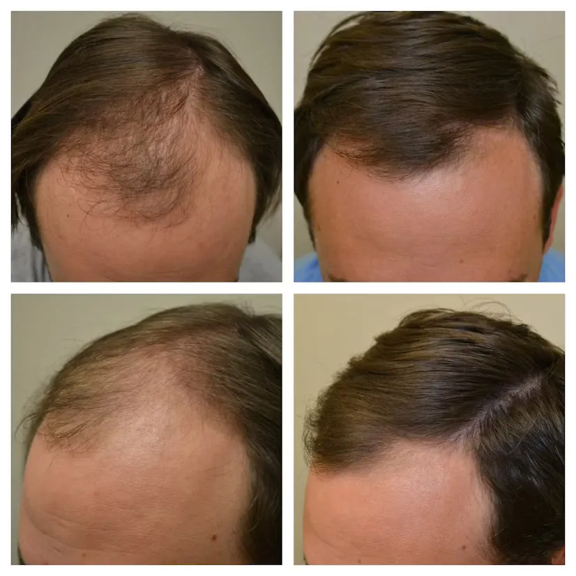 before-and-after-photos-6-months