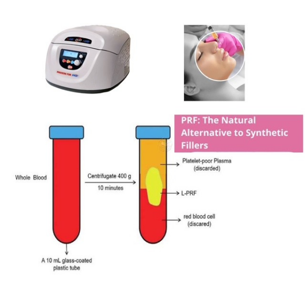 Platelet‑Rich Fibrin (PRF) Filler image